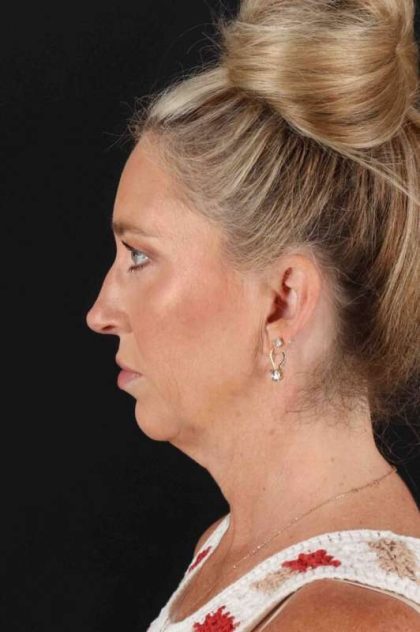 Neck Lift Before & After Patient #6867