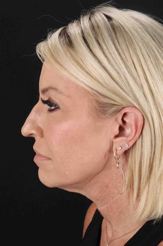 Neck Lift Before & After Patient #6920