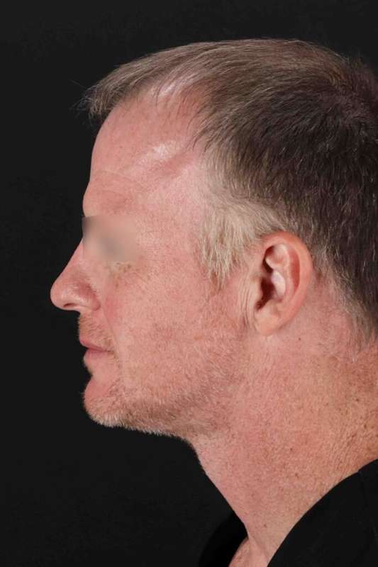 CO2 Laser Before & After Patient #6931