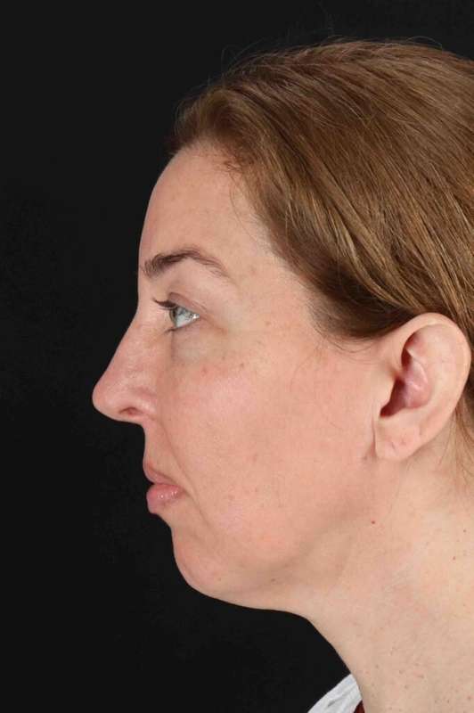 CO2 Laser Before & After Patient #6953