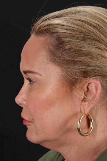 CO2 Laser Before & After Patient #6964