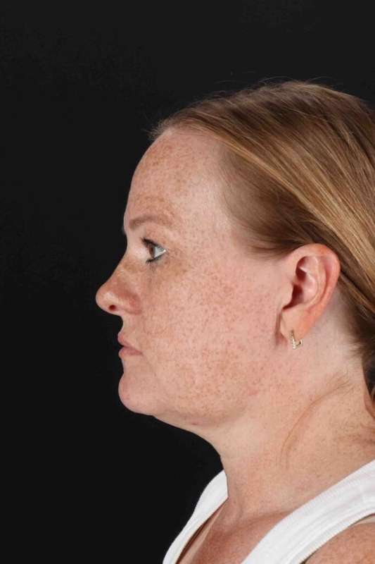 CO2 Laser Before & After Patient #6997