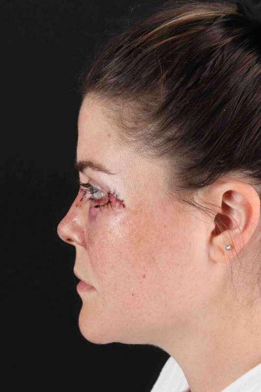 CO2 Laser Before & After Patient #7008