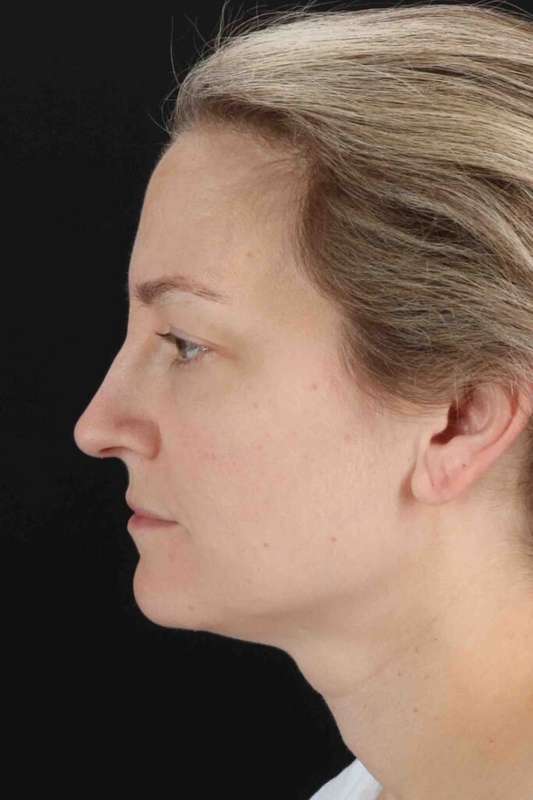 CO2 Laser Before & After Patient #7019