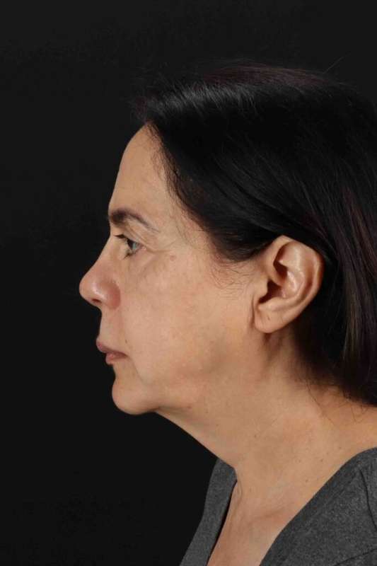CO2 Laser Before & After Patient #7041