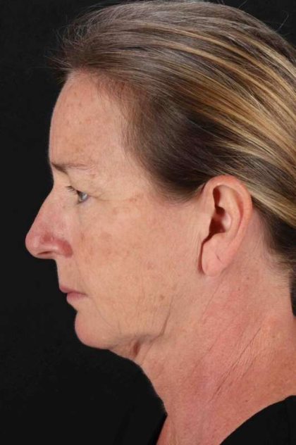 CO2 Laser Before & After Patient #7074