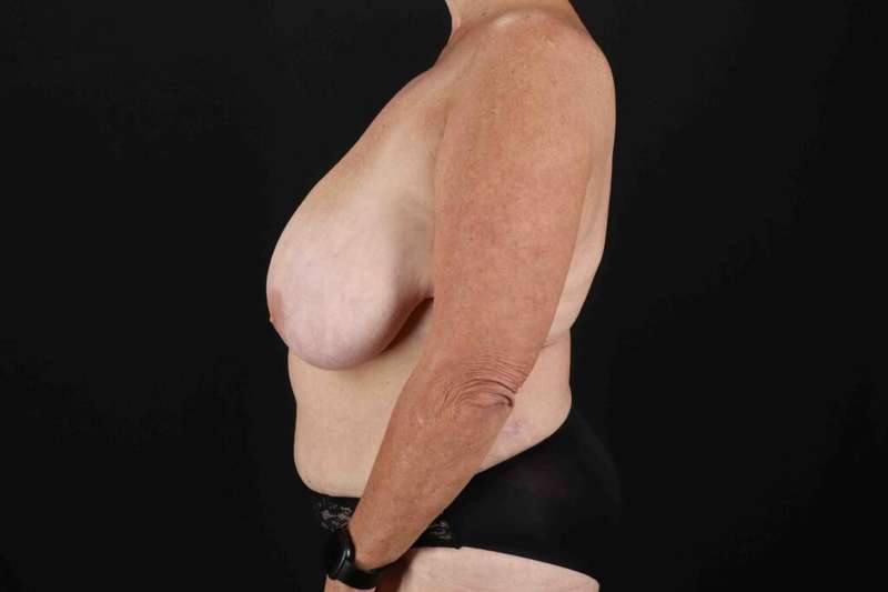 Liposuction Before & After Patient #1348