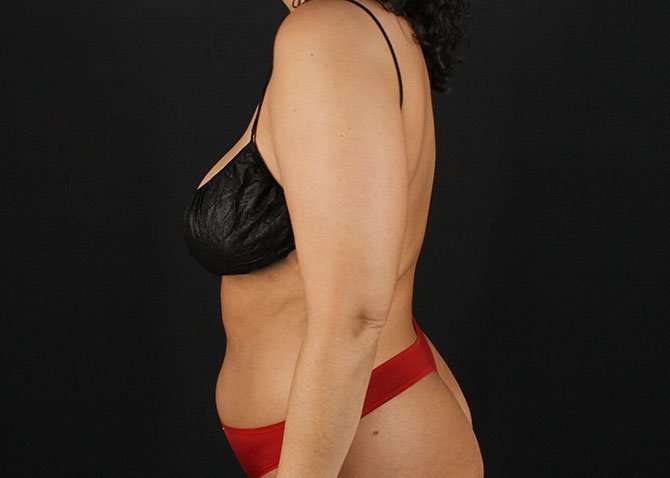 Liposuction Before & After Patient #1469