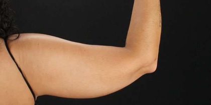 Liposuction Before & After Patient #1482