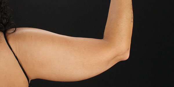 Liposuction Before & After Patient #1482