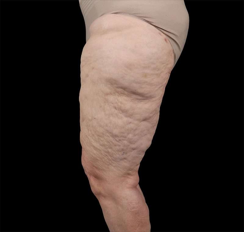 Liposuction Before & After Patient #1495