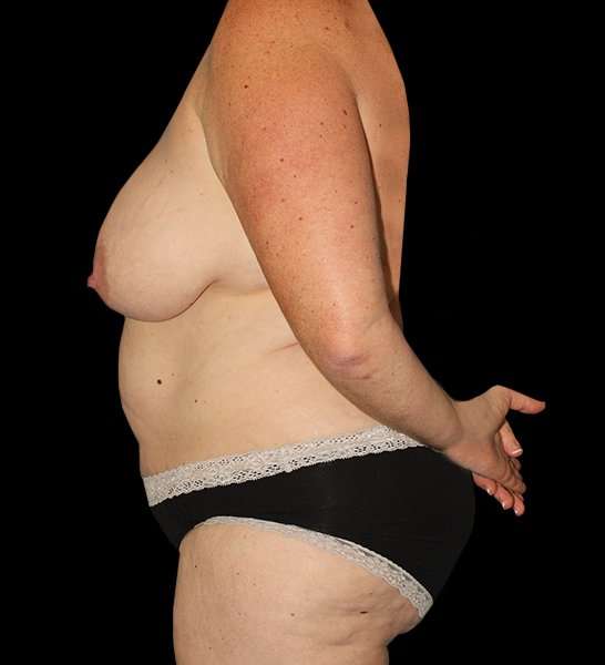 Mommy Makeover Before & After Patient #1535