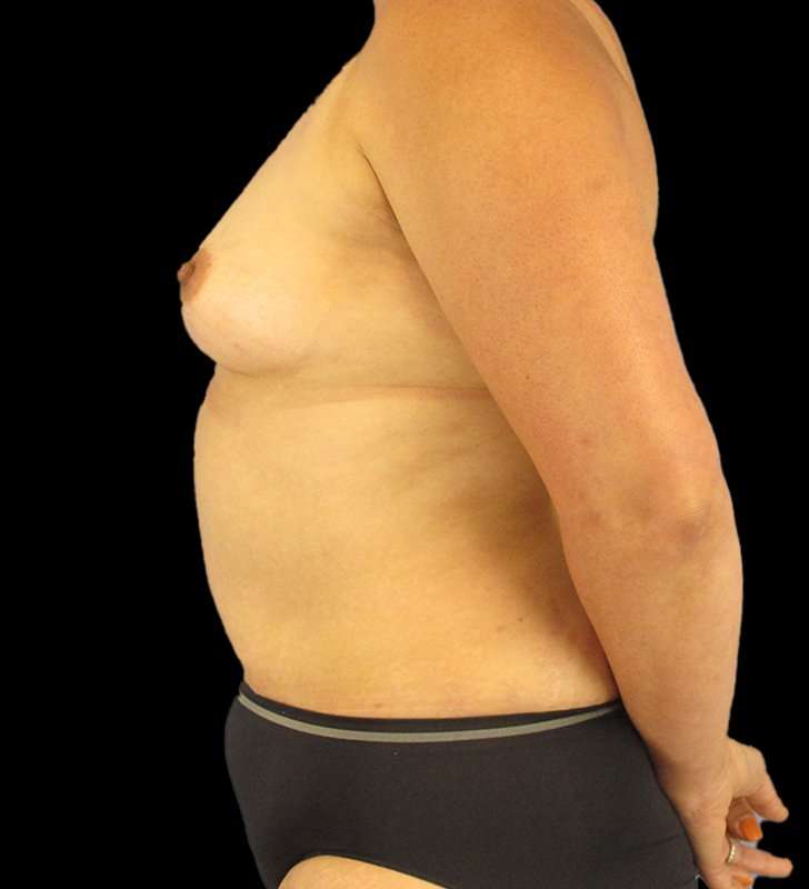 Mommy Makeover Before & After Patient #1547