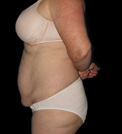 Abdominoplasty (Tummy Tuck) Before & After Patient #625