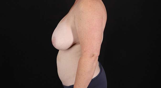 Mommy Makeover Before & After Patient #1597