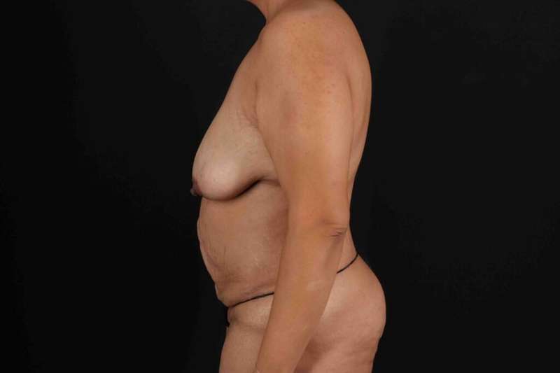 Mommy Makeover Before & After Patient #1637