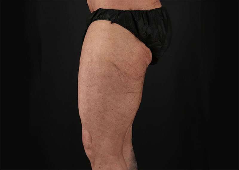 Thigh Lift Before & After Patient #1776