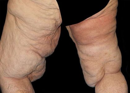 Thigh Lift Before & After Patient #1790