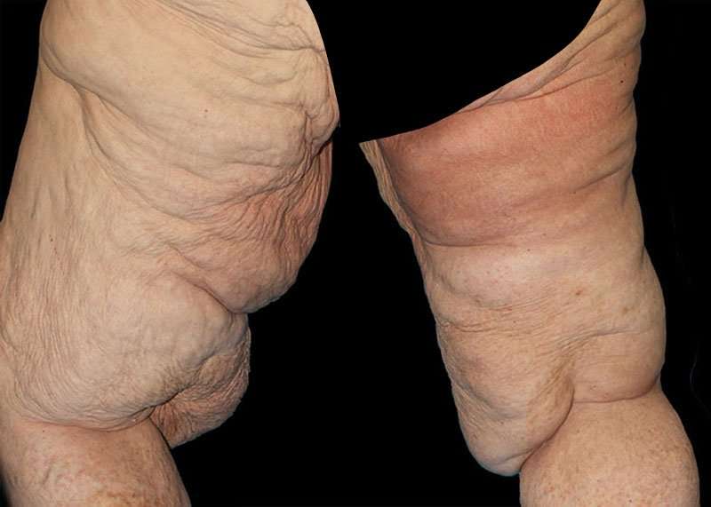 Thigh Lift Before & After Patient #1790