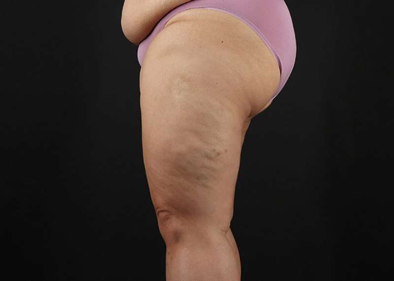 Thigh Lift Before & After Patient #1804