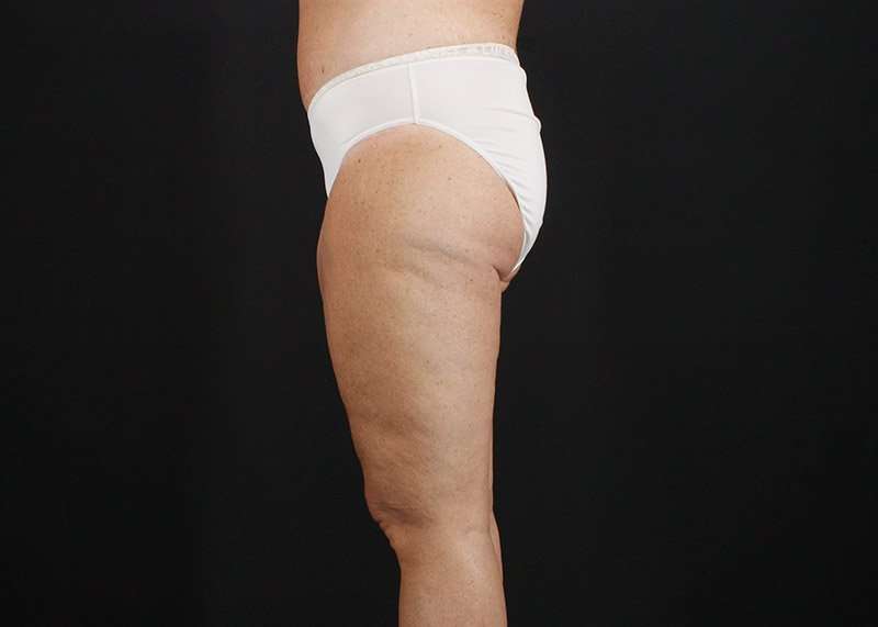 Thigh Lift Before & After Patient #1818