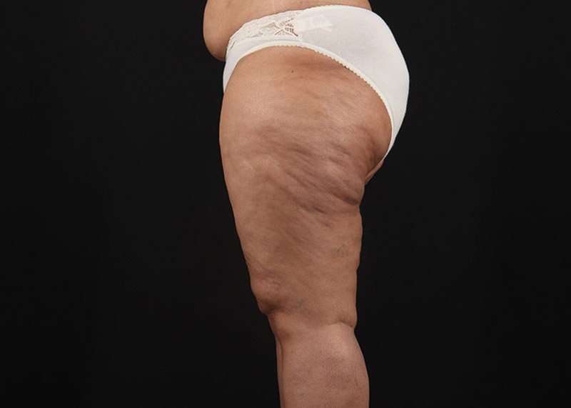 Thigh Lift Before & After Patient #1831
