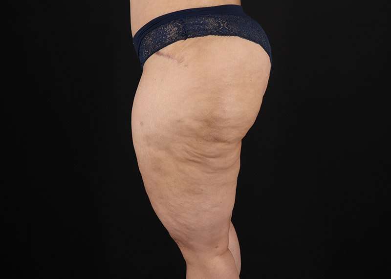 Thigh Lift Before & After Patient #1844