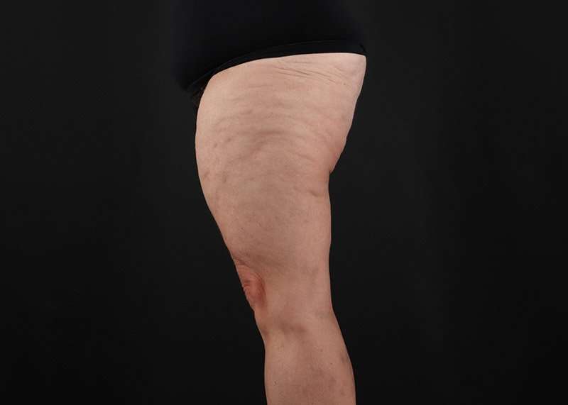 Thigh Lift Before & After Patient #1857