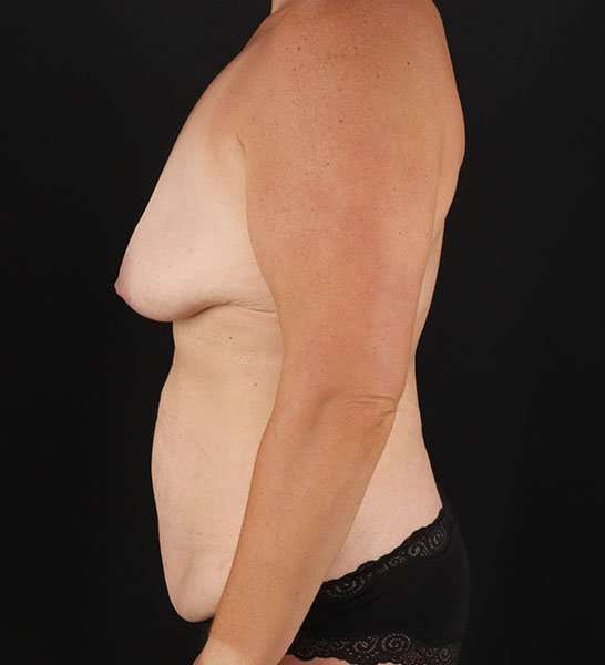 Abdominoplasty (Tummy Tuck) Before & After Patient #653