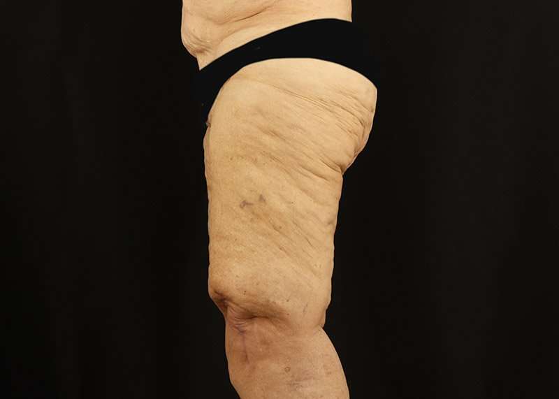 Thigh Lift Before & After Patient #1871