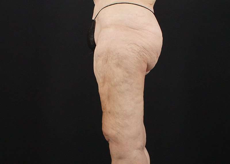 Thigh Lift Before & After Patient #1884