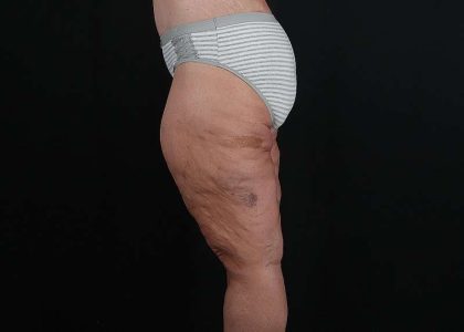 Thigh Lift Before & After Patient #1897