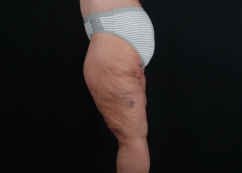 Thigh Lift Before & After Patient #1897