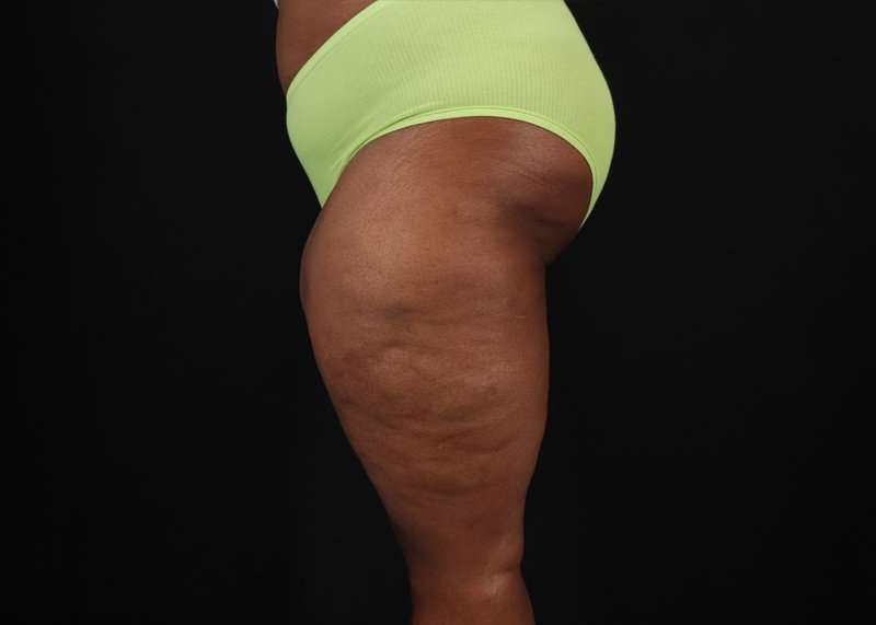Thigh Lift Before & After Patient #1911
