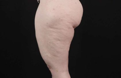 Thigh Lift Before & After Patient #1925
