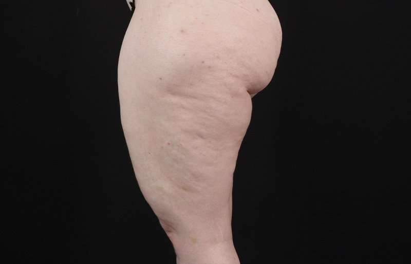 Thigh Lift Before & After Patient #1925
