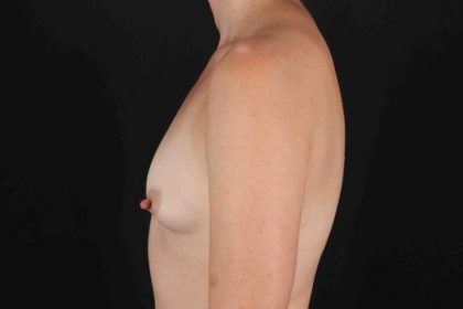 Breast Augmentation w/ Fat Transfer Before & After Patient #2027