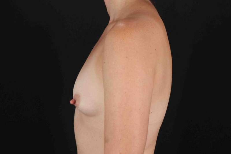 Breast Augmentation w/ Fat Transfer Before & After Patient #2027
