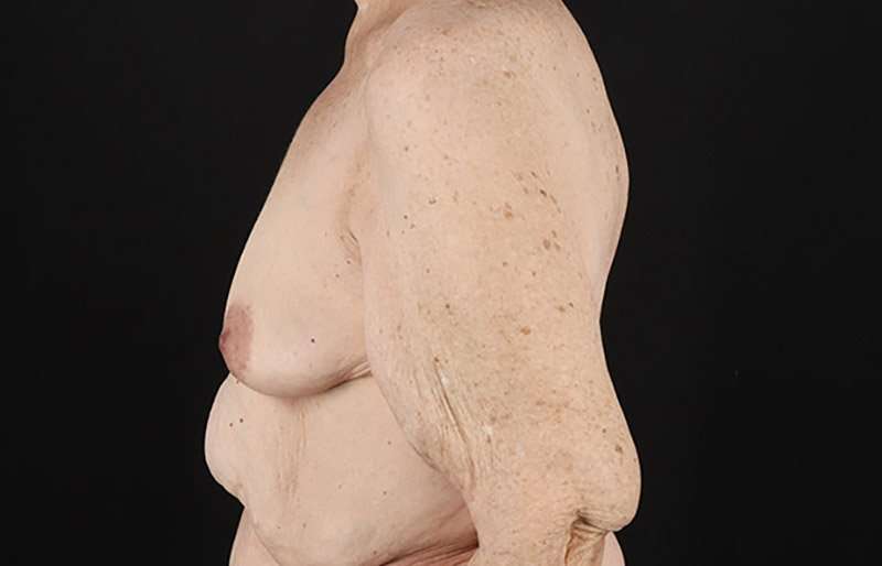 Breast Augmentation w/ Fat Transfer Before & After Patient #2049