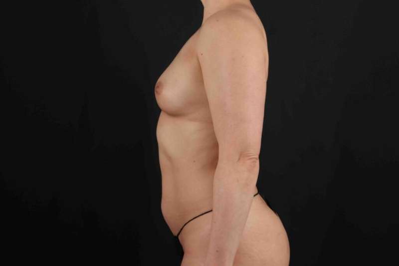 Breast Augmentation w/ Fat Transfer Before & After Patient #2099