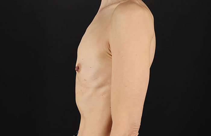 Breast Augmentation Before & After Patient #2110