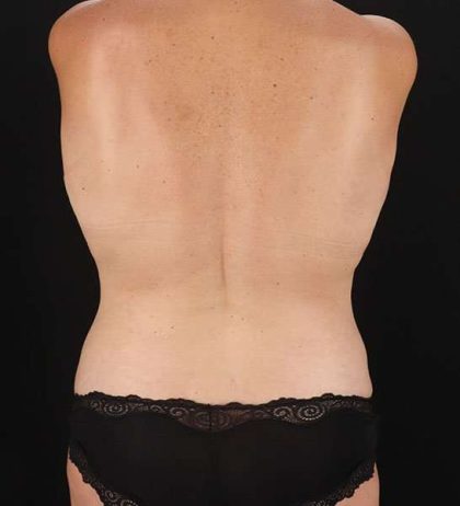 Abdominoplasty (Tummy Tuck) Before & After Patient #653