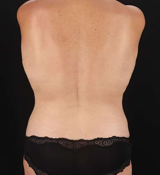 Abdominoplasty (Tummy Tuck) Before & After Patient #653