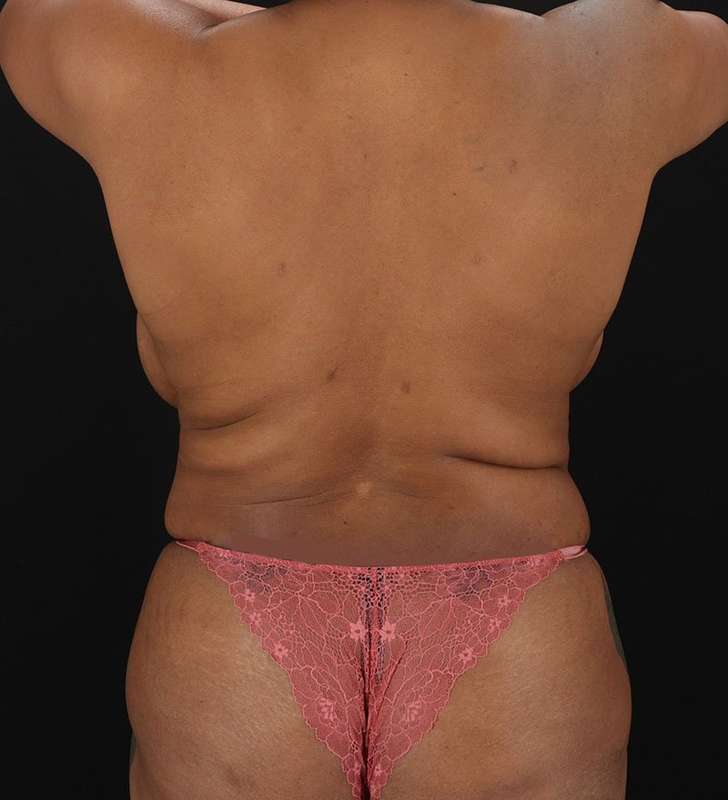 Abdominoplasty (Tummy Tuck) Before & After Patient #990