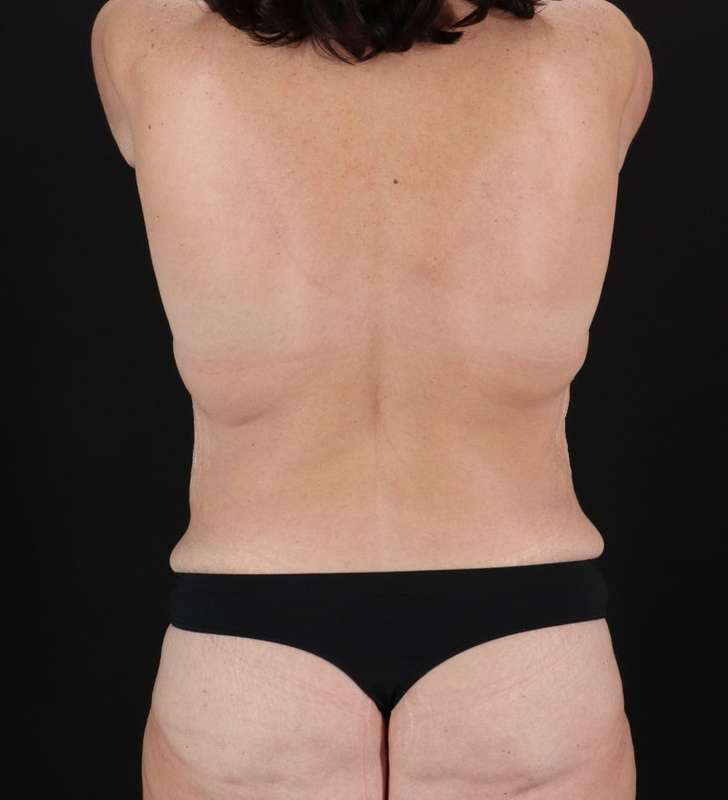 Abdominoplasty (Tummy Tuck) Before & After Patient #1058