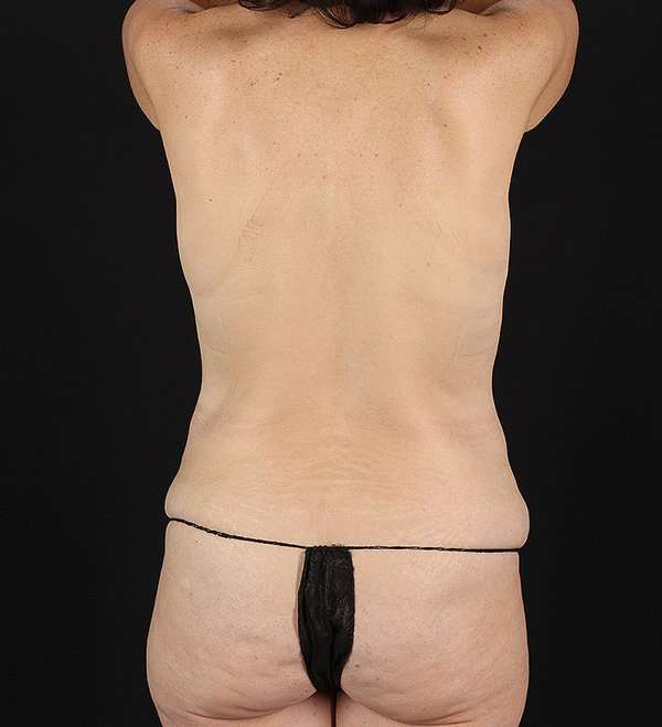 Abdominoplasty (Tummy Tuck) Before & After Patient #1072