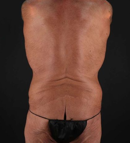 Cosmetic Body Lift Before & After Patient #1200