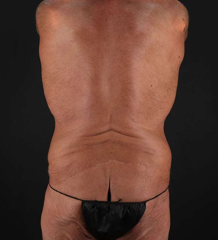 Cosmetic Body Lift Before & After Patient #1200