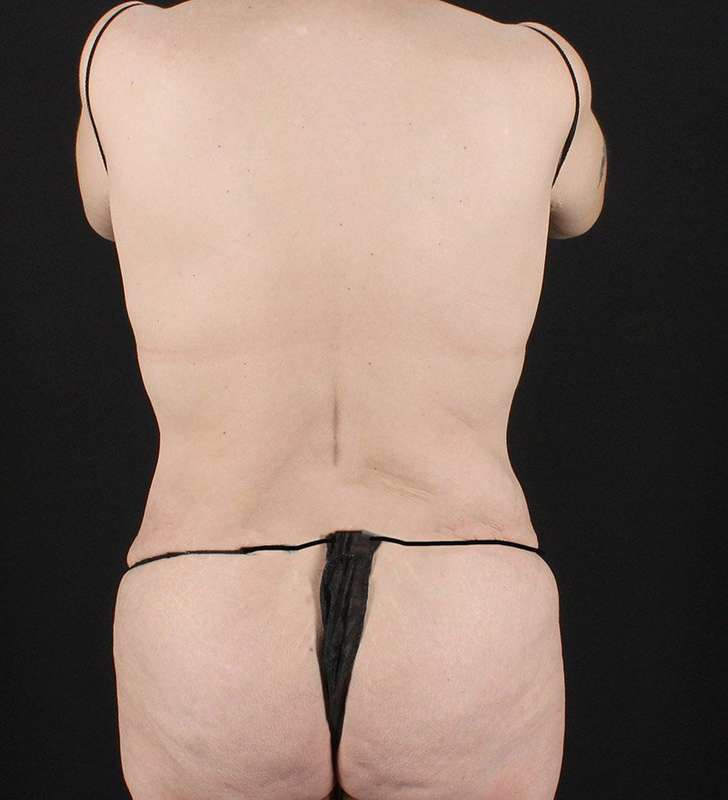 Cosmetic Body Lift Before & After Patient #1218