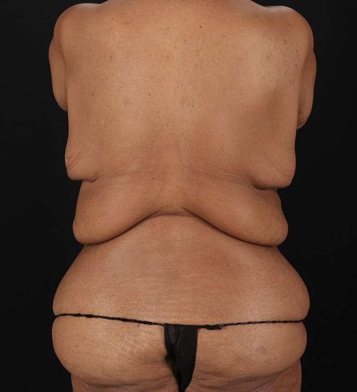 Cosmetic Body Lift Before & After Patient #1234